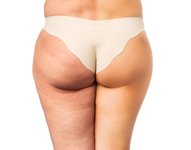 Cellulite Reduktion